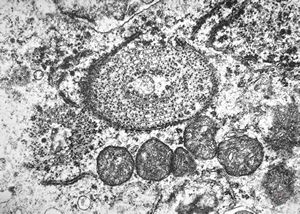 M,41y. | hairy cell leukemia - spleen - ribosome-lamella complex in tricholeukocyte